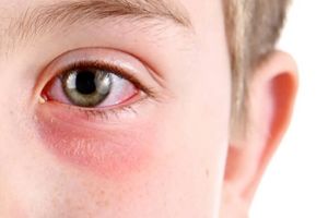کشف درمان جدید التهاب چشم