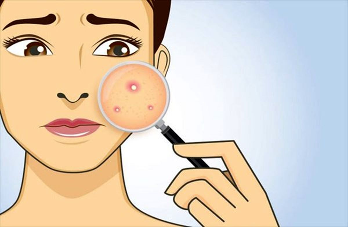 ۷ روش درمان سریع جوش صورت