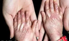 وقتی قطع برق زخم ها را دوباره باز می‌کند/ درد پنهان بیماران پروانه ای