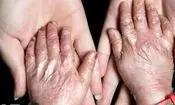 وقتی قطع برق زخم ها را دوباره باز می‌کند/ درد پنهان بیماران پروانه ای