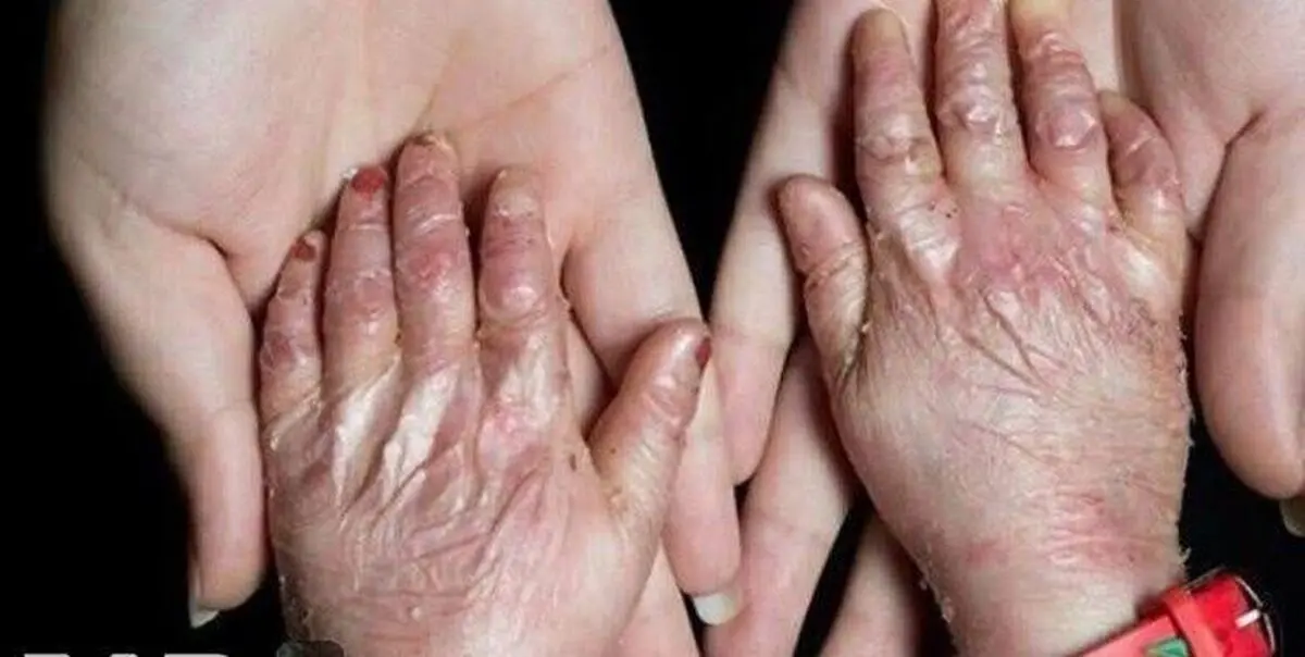 وقتی قطع برق زخم ها را دوباره باز می‌کند/ درد پنهان بیماران پروانه ای