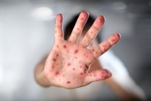 علائم "سرخک" و اهمیت واکسیناسیون کودکان در موعد مقرر