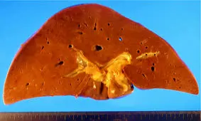 آیا دارویی برای درمان کبد چرب وجود دارد؟ آیا رژیم‌های پاکسازی و سم‌زدایی موثرند؟