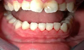 داستان عجیب بیماری اسکوربوت