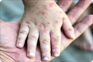 عوارض خطرناک آبله مرغان در بزرگسالی