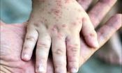 عوارض خطرناک آبله مرغان در بزرگسالی