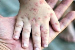 عوارض خطرناک آبله مرغان در بزرگسالی