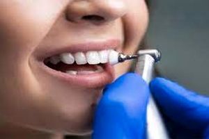 عوارض جرم گیری دندان چیست؟