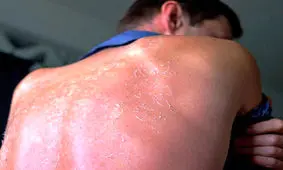 راهکارهایی برای درمان آفتاب‌سوختگی