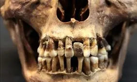 زنی که ۴۰۰ سال قبل دندان‌هایش را «سیم‌کشی» کرده بود 