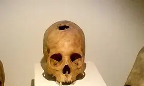 شواهد کوبیدن میخ در جمجمه برای جلوگیری از سرایت بیماری صرع به دیگران