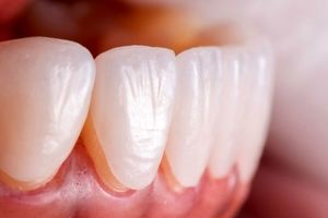 قیمت لمینت دندان چقدر است؟
