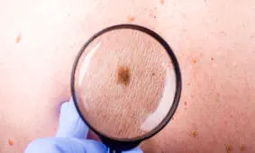 علائم سرطان پوست چیست؟