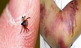 ابتلای یک مورد از ۶ فرد مشکوک به ابتلاء تب کریمه کنگو در یزد تایید شد