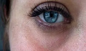 روش از بین بردن حلقه های تیره زیر چشم