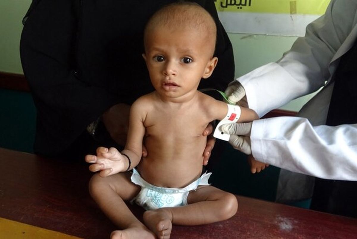 سه چهارم کودکان یمن از سوء تغذیه مزمن رنج می برند