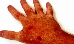  5 ماده غذایی برای کمک به پیشگیری از سرطان پوست/ اینفوگرافی