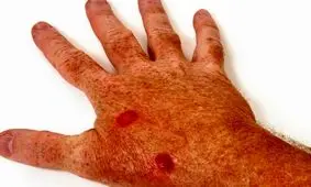  5 ماده غذایی برای کمک به پیشگیری از سرطان پوست/ اینفوگرافی