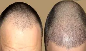 کاشت مو چگونه انجام می شود؟