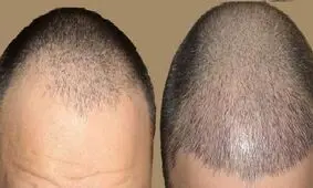 کاشت مو چگونه انجام می شود؟