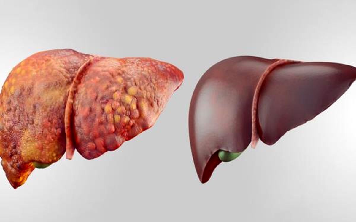 علائم و راهکارهای پیشگیری از کبد چرب/ احتمال انتقال هپاتیت به جنین