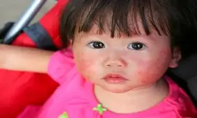 نقش موثر مرطوب کننده ها در جلوگیری از یک بیماری پوستی