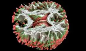 کشف علت واقعی «بیماری ام اس»
