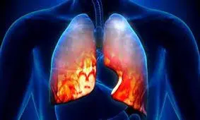 آیا واکسن پنوموکوک به بازار می‌آید؟