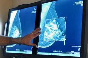افزایش امیدها برای مهار سرطان پستان؛ دانشمندان عامل گسترش تومورها به دیگر نقاط بدن را کشف کردند