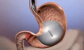 جراحی کاهش وزن به تسکین درد مفاصل در افراد چاق کمک می کند