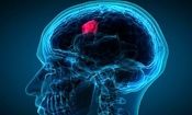 تومورهای مغزی چند نوع هستند؟