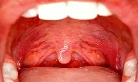 علائم سرطان گلو چیست؟