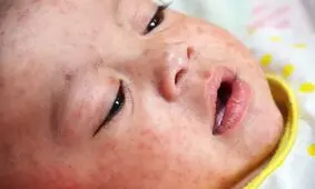 زنگ خطر شیوع دوباره سرخک در جهان به صدا در آمد