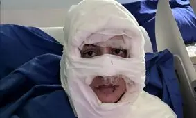 زنی در استانبول به اتهام سوزاندن چهره یک زن جوان روانه زندان شد

