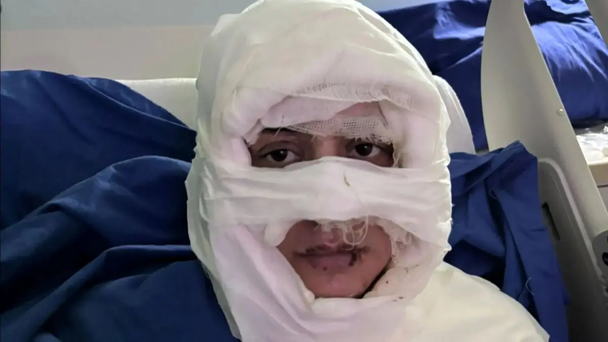 زنی در استانبول به اتهام سوزاندن چهره یک زن جوان روانه زندان شد

