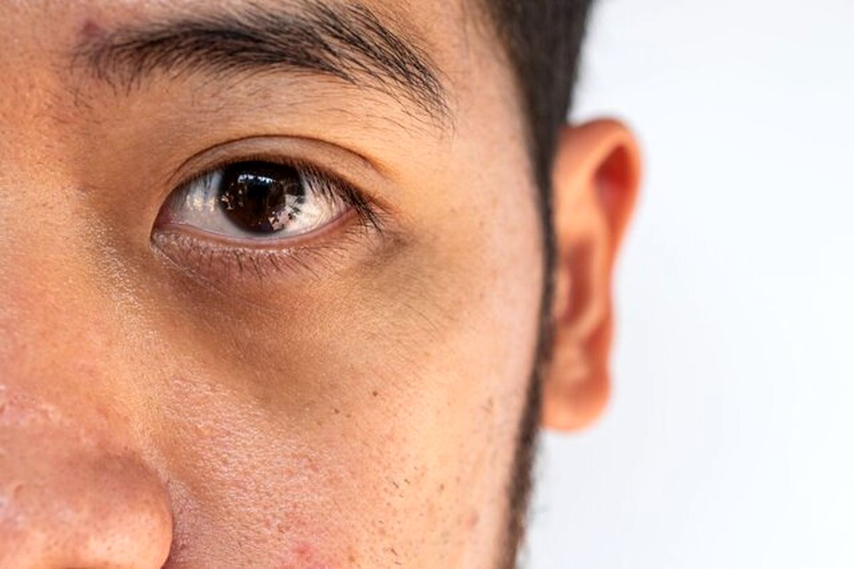 چه عواملی باعث تیرگی دور چشم میشوند؟