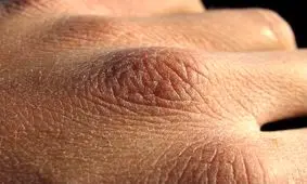 چگونه از خشکی شدید پوست در سرما جلوگیری کنیم؟