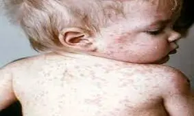 طالبان؛ عامل شیوع سرخک در ایران!