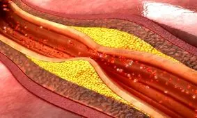 درمان انسداد عروق با تزریق نانوذرات بدون عوارض جانبی

