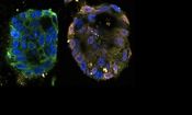 کشف مسیر جدیدی از مرگ سلول‌های سرطانی برای اولین بار

