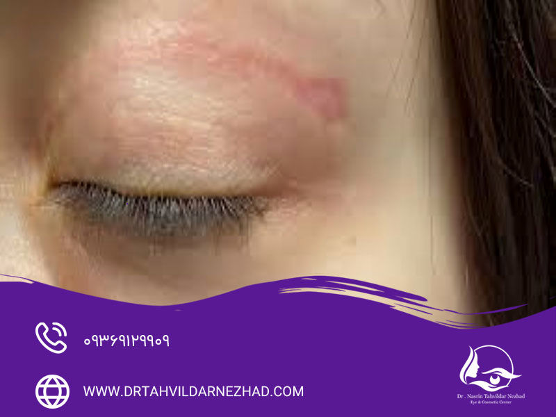 نکاتی مهم در حین فعالیت‌ های فیزیکی بعد از جراحی پلک