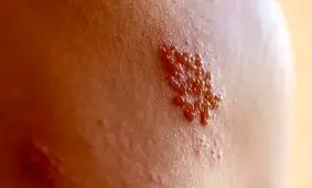 زونا چیست، چه علائم و عوارضی دارد؟