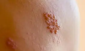 زونا چیست، چه علائم و عوارضی دارد؟