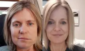 سندرم رامسی هانت: وقتی زونا صورت را فلج می کند!