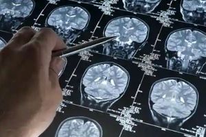 بهبود حافظه در افراد مسن با تحریک الکتریکی مغز