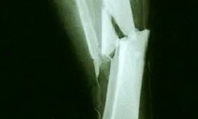 بازماندگان سرطان در معرض خطر بیشتر شکستگی استخوان