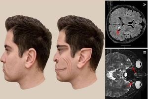 بیماری نادری که باعث می‌شود چهره افراد را شبیه به فیلترهای «تیک‌تاک» ببینید/ عکس
