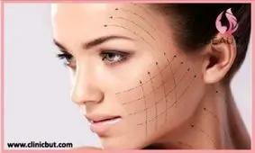 زاویه سازی صورت با تزریق ژل بهتر است یا چربی؟