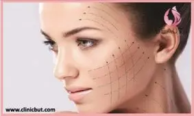زاویه سازی صورت با تزریق ژل بهتر است یا چربی؟