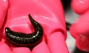 بلعیدن زالو کودک مشهدی را تا یک قدمی مرگ پیش برد